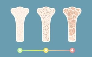 مراحل پوکی استخوان