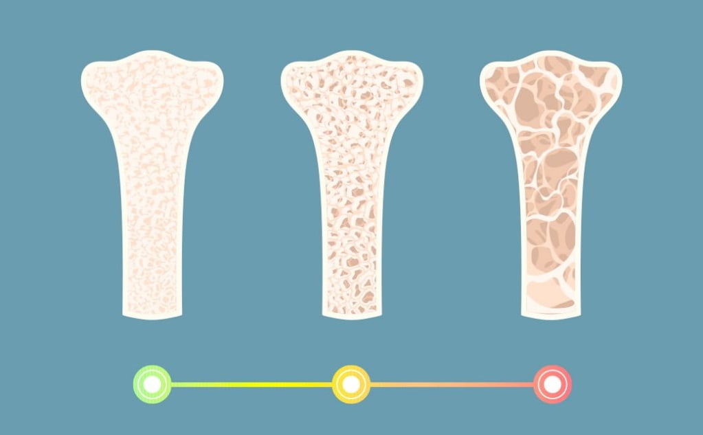 مراحل پوکی استخوان